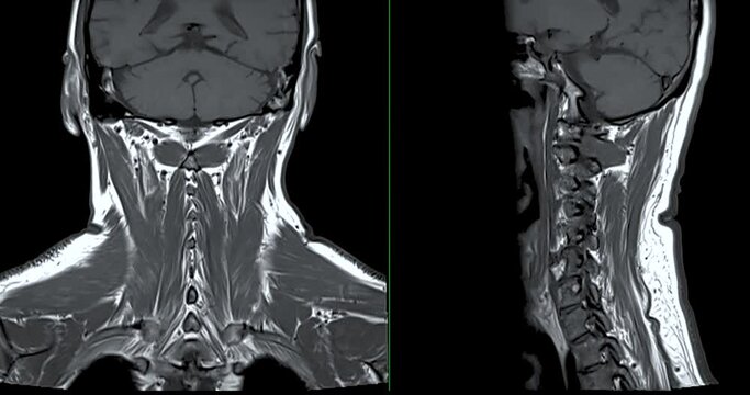 MRI of  C-spine or magnetic resonance image of cervical spine Coronal and sagittal  T2W view  for diagnosis spondylosis and compression fracture.