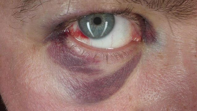 bruise on eye and blood inside, macro shot, man with shiner, closeup view, caucasian male person