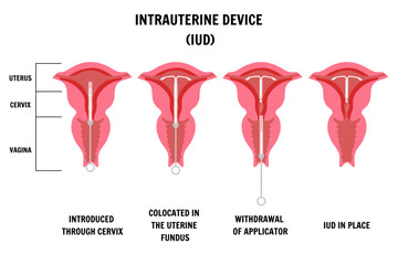 Intrauterine device located IUD