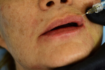 Filler injections. Closeup mature woman lips, procedure augmentation. Syringe female mouth,...