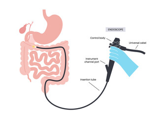 Colonoscopy medical procedure
