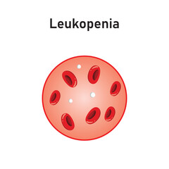 Leukopenia Concept Design. Vector Illustration.