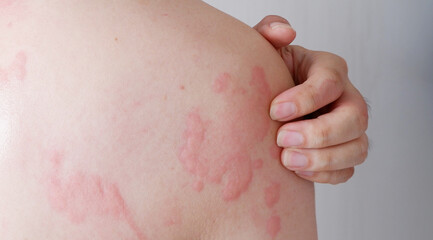 Close up image of skin texture suffering severe urticaria or hives or kaligata. Allergy symptoms.