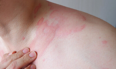 Fototapeta premium Close up image of skin texture suffering severe urticaria or hives or kaligata. Allergy symptoms.