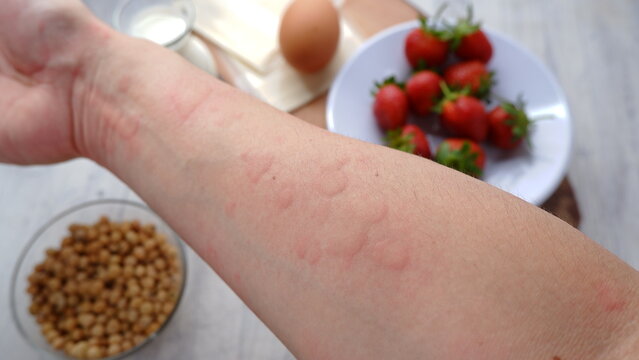 Close up image of arm suffering severe urticaria or hives or kaligata with illustration of allergy trigger foods.  Eggs, milk, beans, strawberry, and chesse.