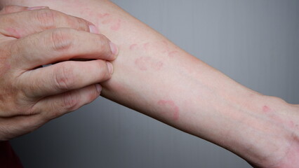 Close up image of arm suffering severe urticaria or hives or kaligata. scratching itchy hands....