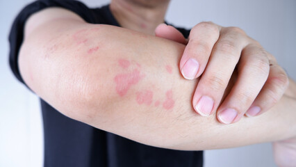 Close up image of arm suffering severe urticaria or hives or kaligata. scratching itchy hands....