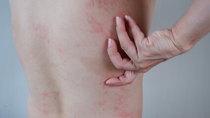 Close up image of skin texture suffering severe urticaria or hives or kaligata on back. Allergy symptoms. - obrazy, fototapety, plakaty