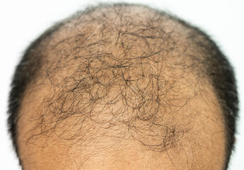 Close up of top view of baldness men's scalp. Baldness is related to your genes and male sex hormones.