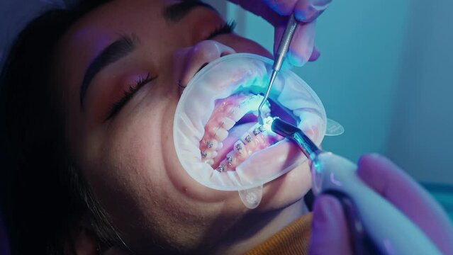 orthodontist bonding braces on teeth by light cure, dentistry