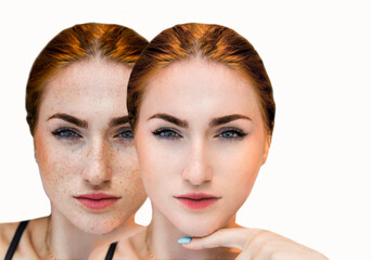 Image before and after spot melasma pigmentation facial treatment on woman face isolated on white....