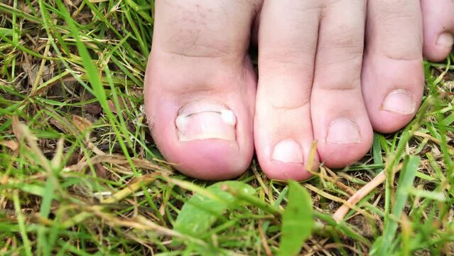 Hardware medical pedicure. Podology. Correction of the shape of the toenail, installation of a titanium staple, threads. Patient undergoing pedicure treatment by a podiatrist. High quality 4k footage
