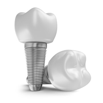 Realistic tooth with implant thread on transparent background in 3d rendering