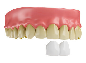 Realistic teeth with lenses and gums in on transparent background in 3d render 