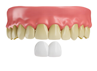 Realistic teeth with lenses and gums in on transparent background in 3d render 
