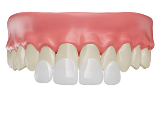 Realistic teeth with lenses and gums in on transparent background in 3d render 