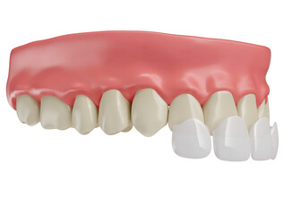 Realistic teeth with lenses and gums in on transparent background in 3d render 