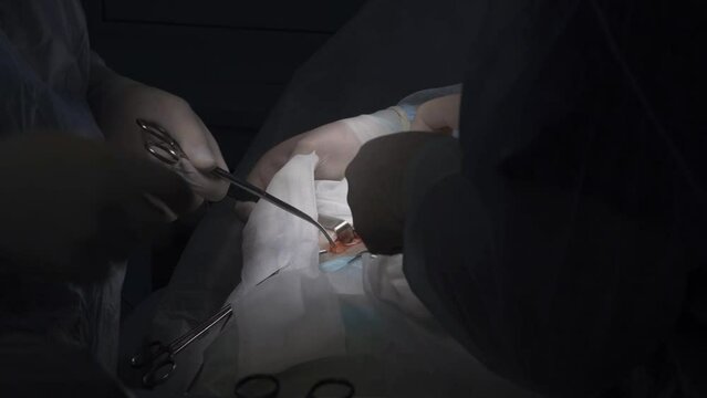 A surgical operation is performed with electrocoagulation equipment.