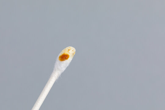 Earwax on cotton swab. Ear health, problems, cleaning and hearing loss concept.
