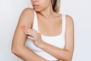 Worried young woman touching an insect bite on her arm isolated on white background. A red rash...