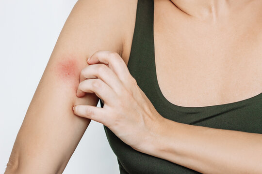 Cropped shot of a young woman scratching an insect bite on her arm. Red rash caused by allergy, inflammatory process. Eczema, atopic dermatitis, lichen, allergy, itching, urticaria, psoriasis