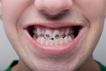 boy's mouth with brackets at the top