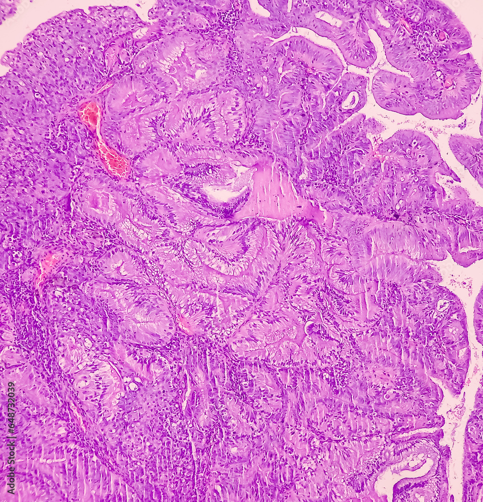 Wall mural Endometrial adenocarcinoma. Uterus cancer. Uterine papillary serous carcinoma (UPSC). Show endometrial tissue of serous papillary type-(G-2).