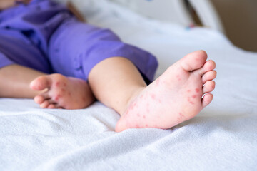Enterovirus foot red spots blisters on the skin of on the body of a purple uniform child virus on...