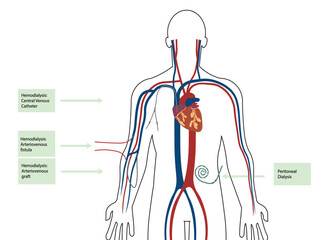 Different types of dialysis illustration. Man body illustration with all types of catheter for hemodialysis  - obrazy, fototapety, plakaty