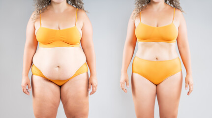Tummy tuck, woman's fat body before and after weight loss and liposuction on gray background, plastic surgery concept - obrazy, fototapety, plakaty