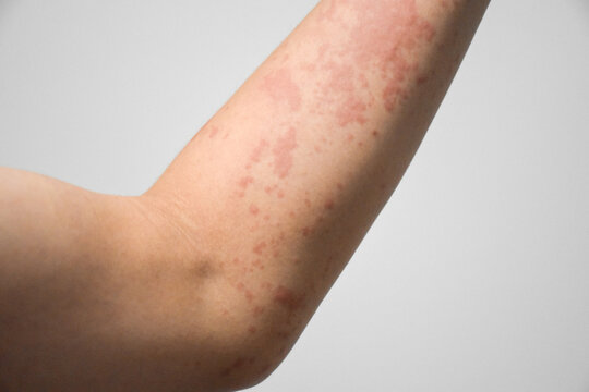 Close up red rash on asian man arm , skin background, arm severely infested with Scabies mites