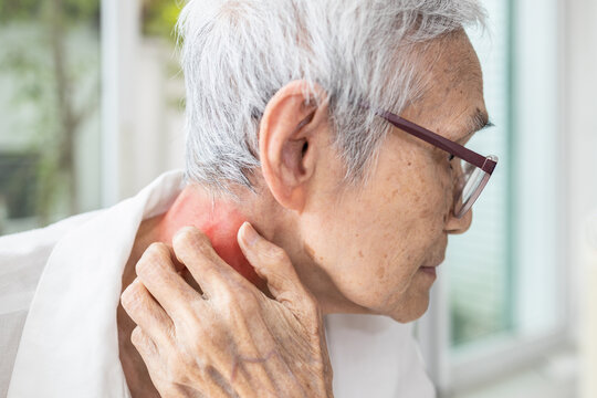 Senior woman scratching her neck,itchy skin,dry skin,Atopic Dermatitis,elderly have an allergic reaction to sweat from hot weather,sweat heat,red rash on her neck or urticaria,itching and irritation