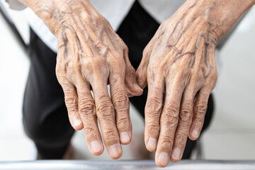 Old elderly woman showing wrinkled hands and bulging vein on the back of hands,veins more...