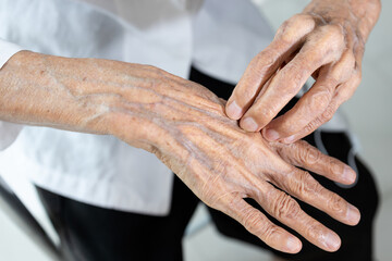 Elderly people scratching hand,itchy dry skin problem,poor circulation,reduced blood flow to the skin,cause dryness and itching,irritation,Unmoisturized or Dehydrated skin,health care,medical concept - obrazy, fototapety, plakaty
