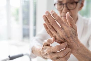 Old elderly scratch her hands,dry skin (Xerosis),Dermatitis problems,itchy skin on the back of hands,contact with irritants or allergens,allergies to certain soaps, detergents,itching and discomfort - obrazy, fototapety, plakaty