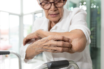 Old elderly scratching arm elbow itchy skin,skin irritation,atopic dermatitis or disorders of nerves and the nervous system,neurological diseases,itching sensations without a visible cause on the skin - obrazy, fototapety, plakaty