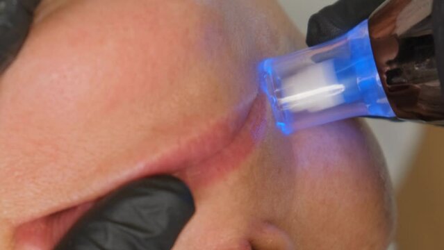 Close-up portrait of a beautiful aged woman during micro needling with dermapen from a beautician.