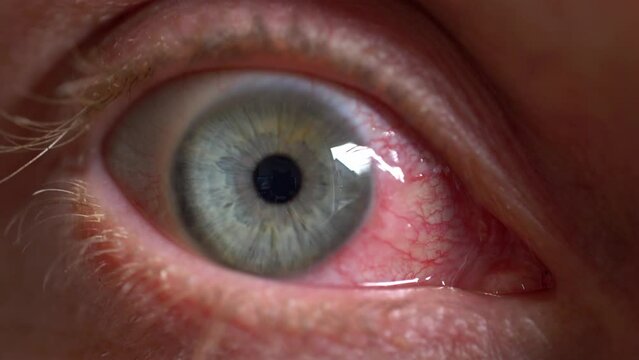 Bloodshot Eye Caused by Ophthalmia Inflammation Sore Exhausted Eyeball