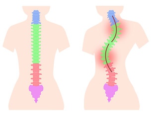 側湾症の背骨のシンプルなイラスト