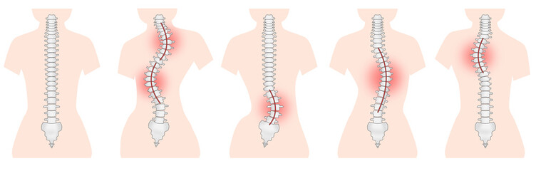 側湾症の背骨のシンプルなイラスト