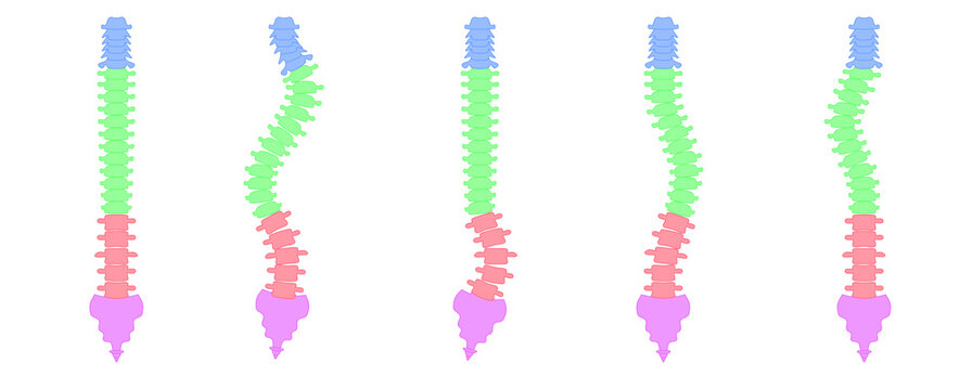 側湾症の背骨のシンプルなイラスト