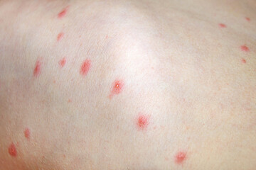 Varicella virus or Chickenpox bubble rash on child