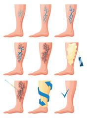 Stages or types of varicose veins development. Medical poster or disease infographic. Image of healthy and diseased legs. Vector illustration in flat style - obrazy, fototapety, plakaty