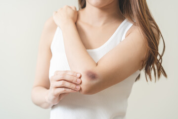 Close up of stain bruise wound on arm, contusion asian young woman, girl an accident fell down...