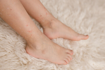 Child's legs with many red spot, from insect bite, mosquitos and fleas