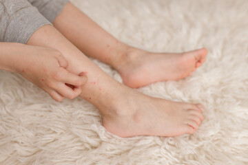 Child's legs with many red spot, from insect bite, mosquitos and fleas