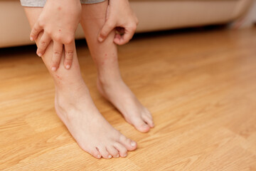 Child's legs with many red spot, from insect bite, mosquitos and fleas