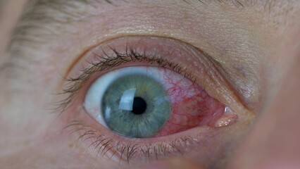 Fototapeta premium Dropping Eye Drops into Bloodshot Eyes Caused by Ophthalmia Inflammation