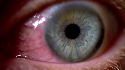 Bloodshot Eye Caused by Ophthalmia Inflammation Sore Exhausted Eyeball
