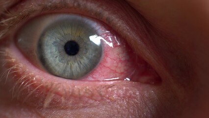 Bloodshot Eye Caused by Ophthalmia Inflammation Sore Exhausted Eyeball